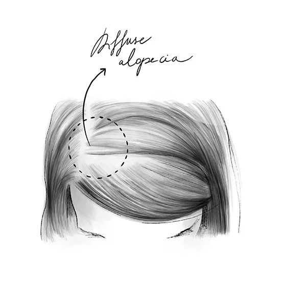 Alopecia diffusa