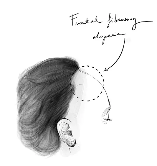 Alopecia fibrosa frontale
